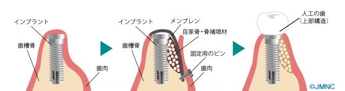 GBR（骨再生）