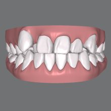 インビザラインで八重歯を治したい