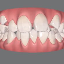 小学生の歯のガタガタをインビザラインで治したい